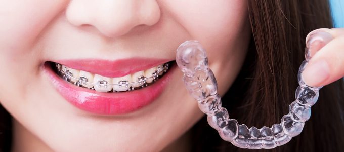 Pemasangan Aligner Gigi Invisalign - www.moderndaysmiles.com