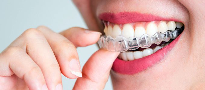 Aligner Gigi Invisalign (sumber: gossipandgab.com)